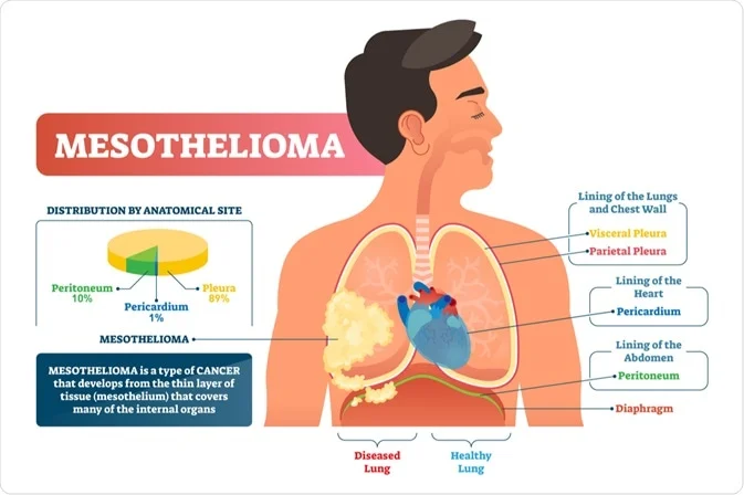 Mesothelioma: A Persistent Threat to Workers and Veterans